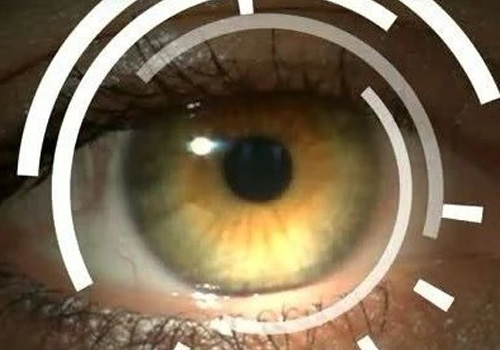 SLT作为开角型青光眼一线治疗的成功预测因素分析