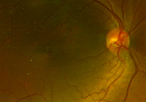 国际眼科盛会，眼后节成像系统有哪些研究热点值得关注？丨ARVO2022