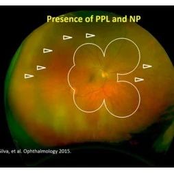 明察秋毫——超广角荧光素眼底血管造影在糖尿病视网膜病变临床管理中的应用