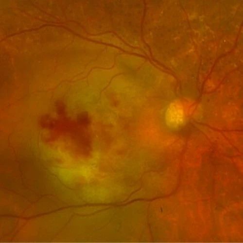 精彩疑例丨玻璃体视网膜淋巴瘤的一则不寻常临床表现