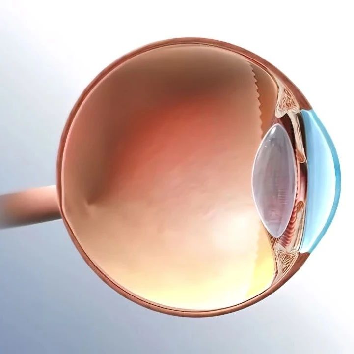 降低眼压能否作为高度近视青光眼未来的治疗方向？